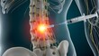 © Artfinity - Medical syringe injecting medicine into human spine. Epidural anesthesia and back pain treatment. Needle entering spinal cord area for nerve block or orthopedic surgery procedure