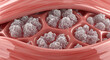 © fia - Close-up 3D render of muscle tissue exhibiting cellular infiltrations; a detailed scientific illustration of pathological changes within biological fibers