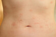 © leroy - Atopic dermatitis on the abdominal skin of a woman, severe itching on the side. Allergy or urticaria, hives.
