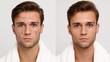 © LimeSky - Young man pre and post acne treatment on plain background Skincare idea
