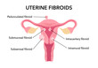 © pasakorn - Flat vector illustration of uterine fibroids, myoma, uterine leiomyomas on dark blue background. There are cervical canal, cervix, vagina, pedunculated, intracavitary, submucosal, subserosal fibroid.