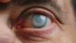 © Hathairat - Eye cataract blindness pupil iris closeup medical disease painful human eye cataract with cloudy pupil and red irritation detail macro medical