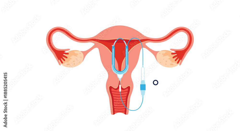 Medical illustration showing the process of an intrauterine device or ...
