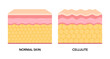 © Orapun - Cellulite and normal skin structure vector illustration.