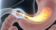 © Lucianastudio - Detailed 3D render illustrating an endoscopic procedure treating inflammation in the human digestive system, showing a glowing fluid stream flowing from a medical device into the stomach with a