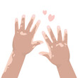 © Marina - Hands with vitiligo, parts of body. Person with pigmentation on skin. Character with Vitiligo skin problems. Close Up, top view. World Vitiligo Day.