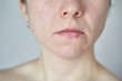 © elenavolf - Caucasian female adult with chapped lips and skin texture close-up showing dryness and natural facial features.