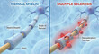 © Medical Comparisons - Multiple Sclerosis Demyelination and Normal Nerve Myelin Sheath