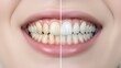 © Iuliia - Woman teeth with before and after whitening result. Dental health and toothpaste advertisement concept. Oral hygiene and aesthetic dentistry.
