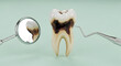 © uni - Dentist examining tooth with decay and dental tools