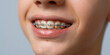 © Artificial South - A close-up shot of a person smiling, showcasing teeth with braces