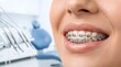 © Hiskia - Close up of smiling woman wearing metal dental braces in modern orthodontic clinic, highlighting teeth alignment treatment, oral healthcare procedure, and confident smile transformation concept.