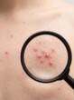 © PLATİNUM - Close-up view of acne pimples on human skin magnified by a magnifying glass