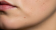 © Pixel Prism - Acne on woman's cheek
