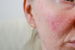 © AnastasiiaAkh - Red irritated skin with rosacea and visible pores on female cheek close up