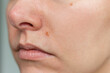© Ольга Шефер - Mole above the lip on the face of a young woman increases in size. Indications for removal. Examination of moles. Moles on the body. Neoplasms.