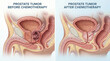 © Medical Comparisons - Prostate Cancer Tumor Before and After Chemotherapy Treatment Comparison