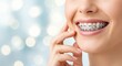 © gankevstock - Close-up of a smiling woman's face with metal braces on her teeth