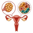 © BillalHossan - Illustration of female reproductive system focusing on ovary and uterine structure isolated on transparent background
