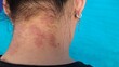 © kuncron - portrait the rash and hives, reaction and urticaria, eczema and epidermis, allergic and psoriasis, inflammation skin on the neck, health care and  medical concept.