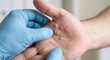 © Unimaginable Pic - Medical professional in protective gloves examines a patient's hand displaying multiple epidermal growths, indicating a common skin disease requiring diagnosis and treatment for improved health