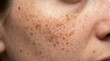 © Moonroad - Close up skin face freckles brown spots texture natural healthy female cheek
