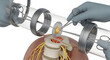 © Arfin Mehedi - A close-up of a surgical procedure on a spinal cord