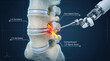 © Moonroad - Lumbar spine herniated disc compressed nerve spinal surgery medical illustration robotic surgery l4 vertebra l5 vertebra nerve root minimally invasive lumbar spine herniated disc compressed nerve