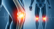 © MST - Human knee joint showing painful inflammation with skeletal structures highlighting medical orthopedic conditions