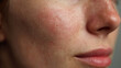 © Valena - Closeup of female cheek with mild redness and healing dermatitis showing textured skin, visible pores, and facial irritation in soft light