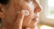 © Yauhen - Close up woman with hyperpigmentation applying white cream to her cheek. This image represents skincare routine for sun damaged or sensitive skin. Ideal for dermatology and beauty articles.