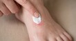 © Sugar Love Love - Applying medicinal ointment to irritated skin on foot