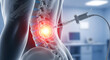 © designhunt - Epidural injection and spinal pain management. Medical procedure and anesthesia concept. Syringe needle injecting medicine into a glowing red human spine