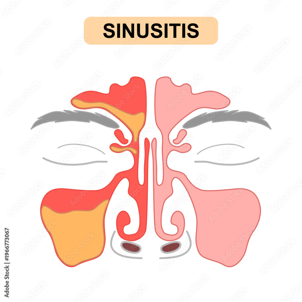 Sinusitis Medical Illustration Showing Healthy vs Inflamed Paranasal ...