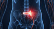© NawManusia - 3D rendering of a human torso showing a spinal cord stimulator implant with radiating pain or nerve stimulation.