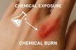 © Chanita - Painful close up of chemical burn on human skin. hand shows red inflamed patch, severe irritation from chemical exposure, explained with medical illustration overlay