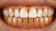 © Enrique - Human Teeth with Yellow Coffee Stains and Enamel Discoloration for Dental Care