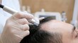 © ArtFocus Studio - A close-up shot of a professional dermatologist performing a microneedling treatment on a male patient's scalp to stimulate hair growth and rejuvenate the skin in a medical clinic setting.