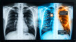 © Nurmora AI Studio - Innovative medical technology showcasing an AI-driven X-ray interpretation, identifying critical health markers like nodules and fracture vulnerabilities, for advanced diagnostic imaging analysis
