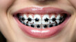 © PhotoBank - Smiling young woman with black star shaped dental braces on teeth