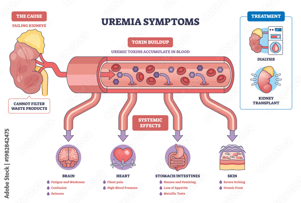 Systemic Effects Image vectorielle Stock Uremia symptoms diagram visualizes failing ...