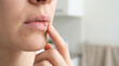 © Moonroad - Dry cracked lips chapped lips lip injury finger touching lip close up skin texture lip care human face mouth healthcare wound healing skin damage personal care lip dryness natural skin female