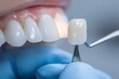 © Ilia K - Professional dentist hand holding ceramic veneer before installation, cosmetic dentistry for perfect white smile, dental restoration process, tooth crown replacement