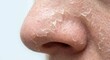 © Sugar Love Love - Skin peeling on nose after professional chemical peel