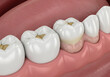 © Jignesh - Close-up view of healthy white teeth and gums in a human mouth