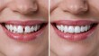 © Kristina - Dental before and after diastema closure treatment comparison of female smile