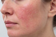 © donlawat - Close-up of a person's face showing skin condition