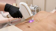 © Nano Medical Art - Close-up of Man Having Laser Hair Removal on Torso Area in Dermatology Clinic