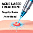 © al - Create a realistic Isolated a realistic Acne laser treatment, Laser shot to acne head. 3D rendering. vector art with white background..
