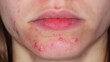 © pengfei - High-Resolution Medical Illustration of Herpes Simplex Virus Infection Showing Cold Sore Outbreak, Viral Skin Disease, Dermatology Healthcare Concept and Microscopic HSV Particles